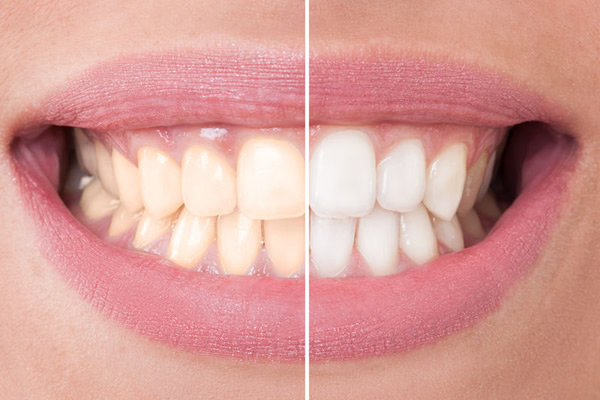 Tooth Whitening